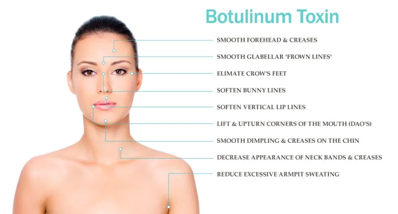 Antirrugas para adelgazar Beutox Batulaxs Resty Dermal Filler Juvederms 0