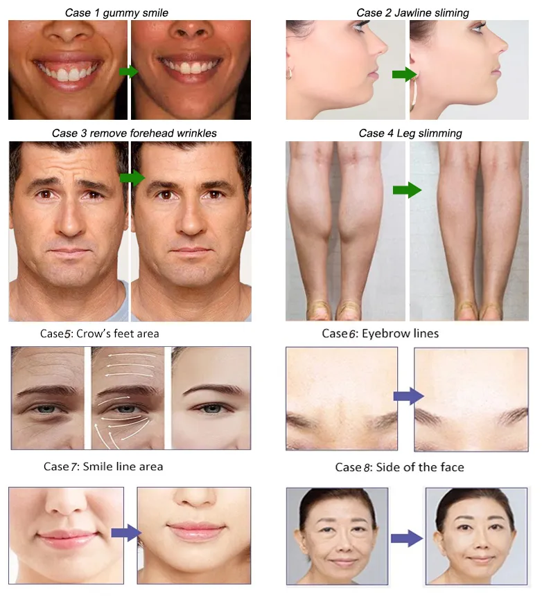 Antirrugas para adelgazar Beutox Batulaxs Resty Dermal Filler Juvederms 1